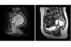左が子宮癌、右が子宮筋腫