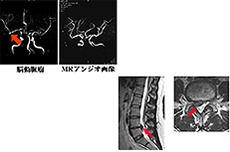 左上は脳のMRA画像<br>右下は椎間板ヘルニアの画像