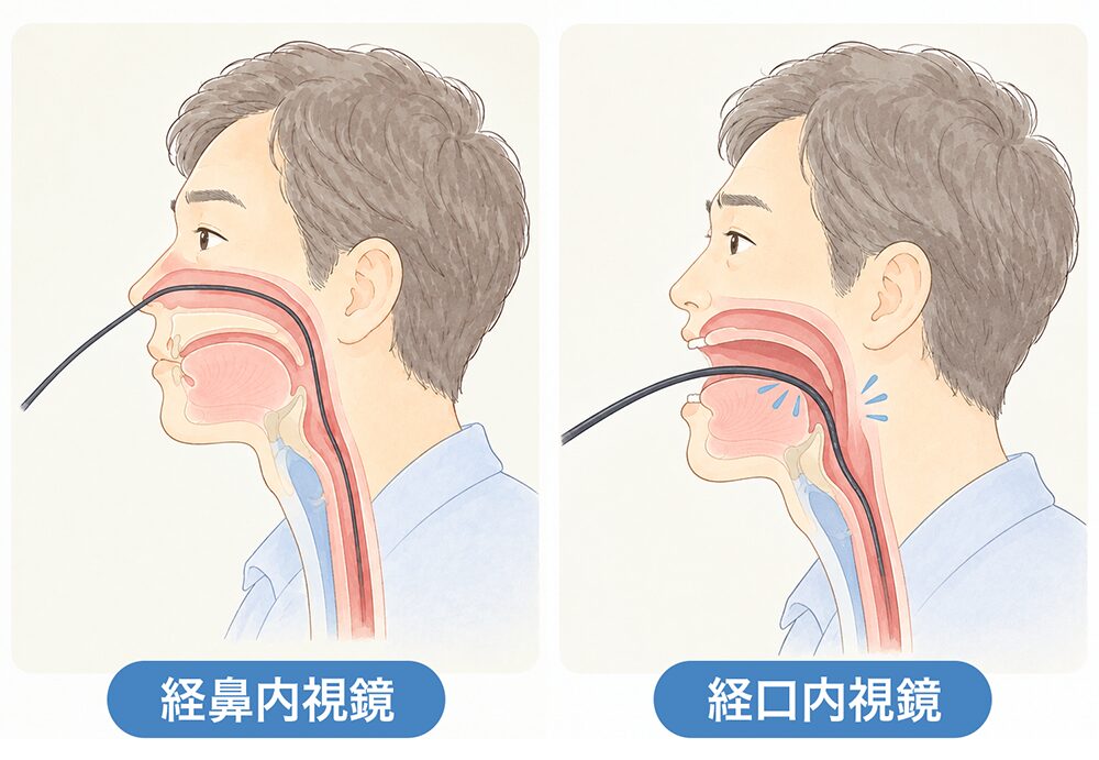 経鼻内視鏡と経口内視鏡